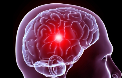 cicatrices y migraña terapia neural y medicina biológica